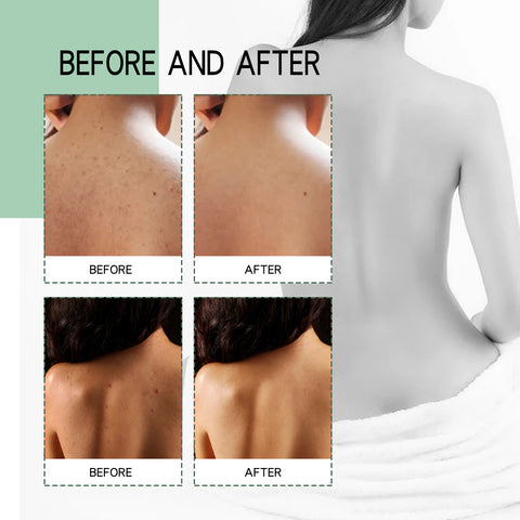 Back Acne Repair Back Shoulder Acne Desalination Acne Mark Skin Care Spray